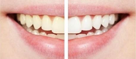ماهي الأغذية التي تؤدي إلى اصفرار الأسنان؟